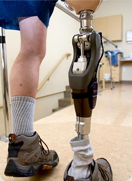 Plastic Above Knee Prosthetic Leg, Myoelectric